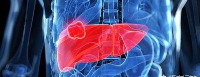 肝功能衰竭与肝癌有什么区别,肝癌患者的肝功能如何图3