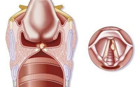喉咙长息肉危险吗