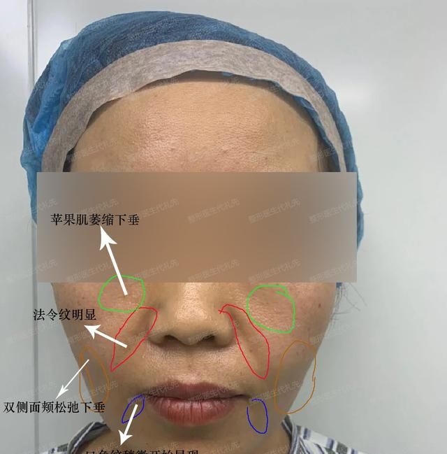 面部提升面部拉皮手术，面部提升去皱，面部提升分为除皱与提升