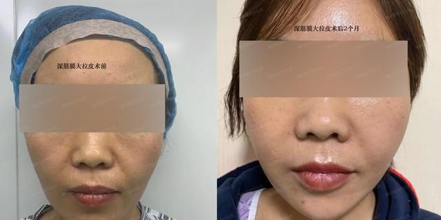 面部提升面部拉皮手术，面部提升去皱，面部提升分为除皱与提升