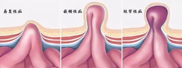 疝气是什么,疝气是什么病图2