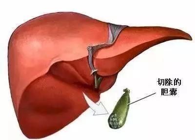 胆囊切除后饮食方面要注意什么,胆囊切除以后饮食需要注意什么图6