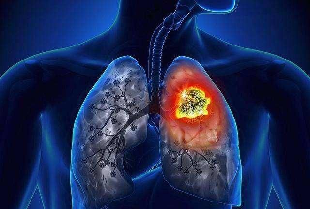 肺癌容易复发的根本原因是什么,肺癌复发一般哪个部位容易复发图4