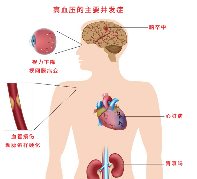 芹菜、木耳不降血压，真正降血压的只有一个