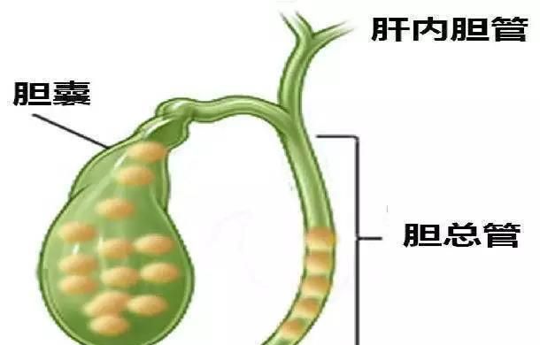 胆结石多大算严重(胆结石到底怎么治疗好)图4