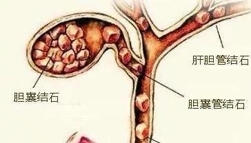 胆结石多大算严重(胆结石到底怎么治疗好)图9