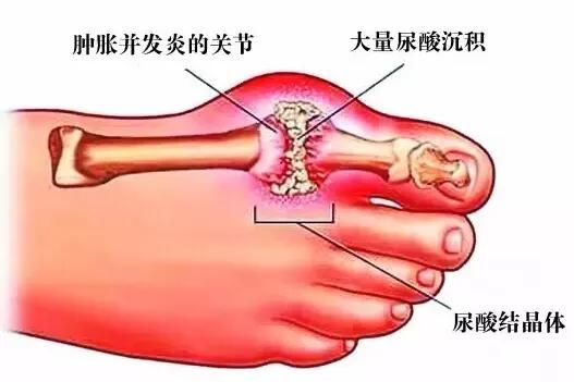 高尿酸的人什么时候锻炼最好,降尿酸最好的锻炼方法图13