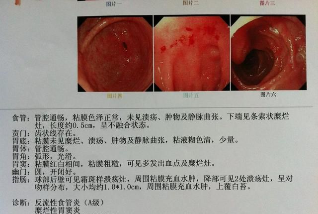 十二指肠溃疡吃什么药好图1