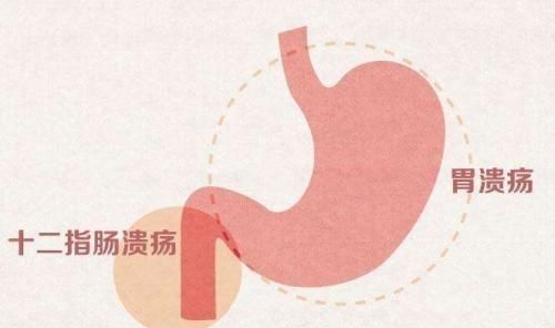 十二指肠溃疡吃什么药好图6
