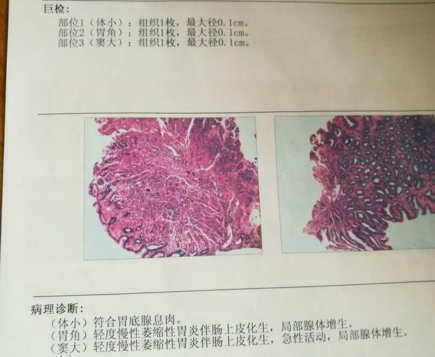 慢性浅表萎缩性胃炎能够治愈吗图1