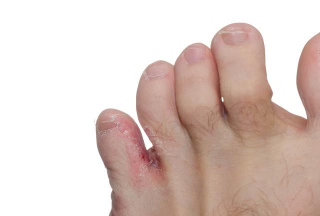 皮肤常见疾病系列：顽固的足癣、脚气、香港脚