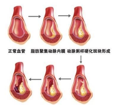 血栓是什么(血栓是什么病引起的)图1