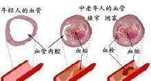 血栓是什么(血栓是什么病引起的)图3