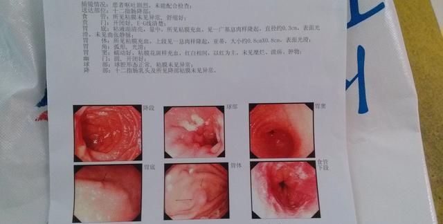 胃里有息肉怎么办图2