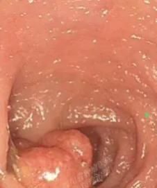 胃里有息肉怎么办图6