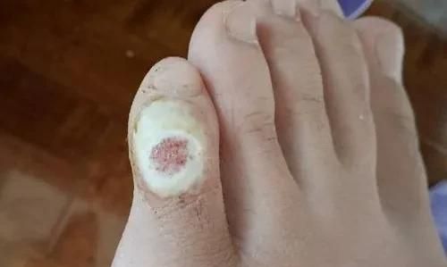 鸡眼是怎么形成的 原因,鸡眼是怎么形成的如何去除图1