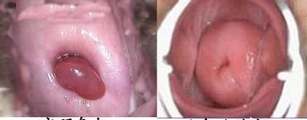宫颈息肉怎么控制,宫颈息肉处理容易吗图11