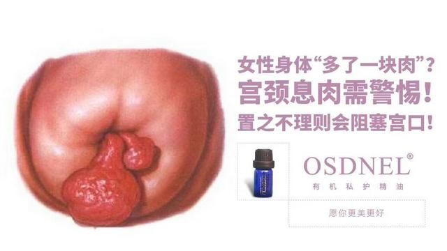 宫颈息肉怎么控制,宫颈息肉处理容易吗图13