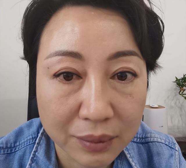 47岁女士“泪沟填充+面部提升”全程记录，40天后大变样