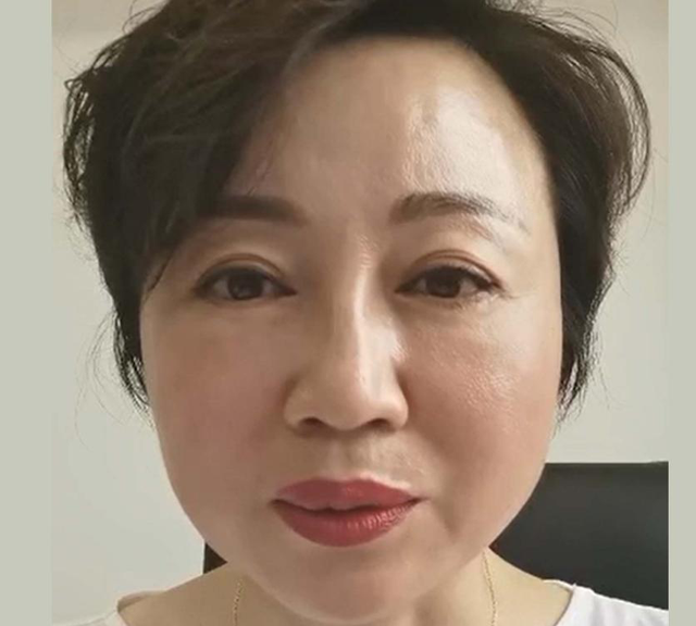 47岁女士“泪沟填充+面部提升”全程记录，40天后大变样