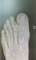 一根小铁钉“蛀”空大脚趾