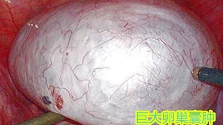 怎么判断是卵泡和卵巢囊肿呢图3