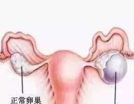 怎么判断是卵泡和卵巢囊肿呢图4