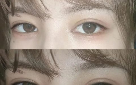 单纯脂肪型肿泡眼可以做眼部吸脂吗