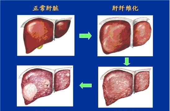 转氨酶高是因为有肝炎吗,转氨酶高出多少为肝炎图6