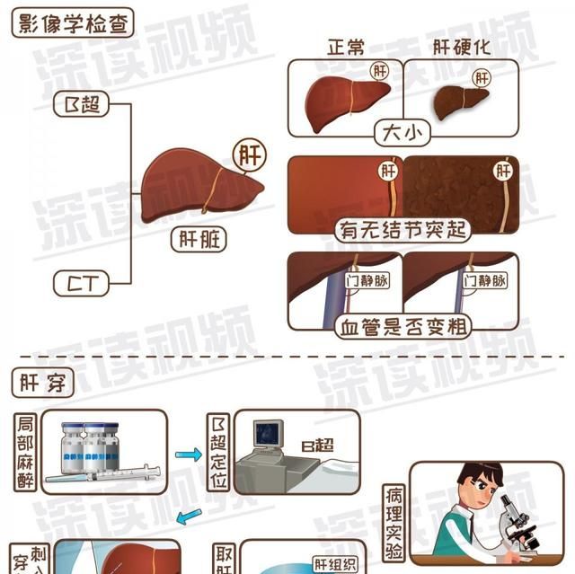 早期诊断肝硬化的主要依据图3