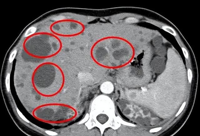 肝囊肿的出现，多与这3大因素有关，可惜很多人不了解