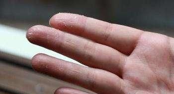手指大面积脱皮是怎么一回事,手指剥落性脱皮怎么治疗图1