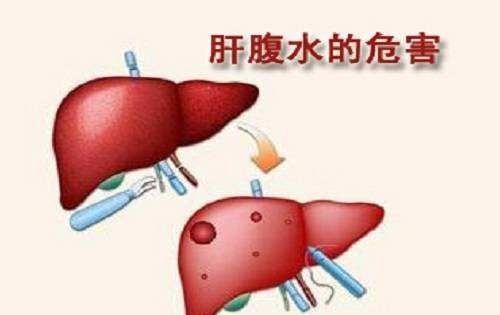 得了肝腹水还能活多久,已经肝腹水了还能活多久图1