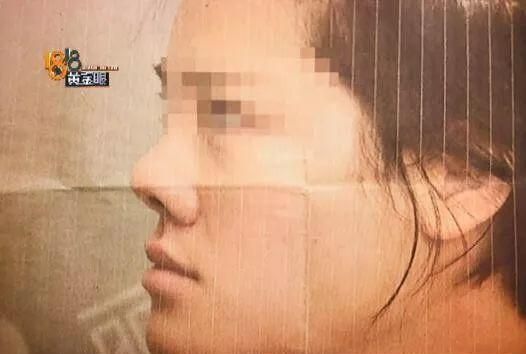 女子花5万整容 鼻子变得“跟猪一样”还丢了工作