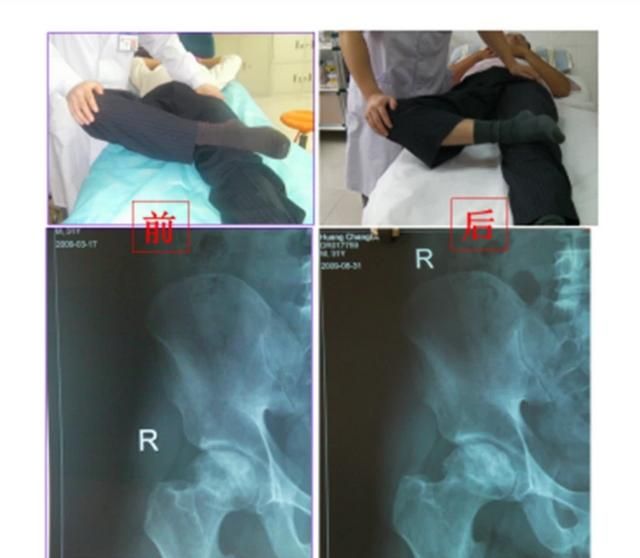 有哪些方法可以治疗股骨头坏死(治股骨头坏死全国十佳医院排名)图1