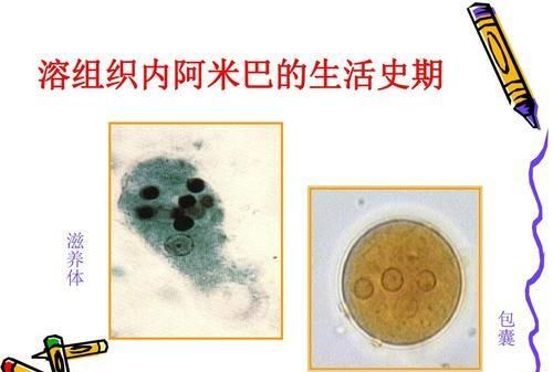 阿米巴肝脓肿发烧会有生命危险吗图1