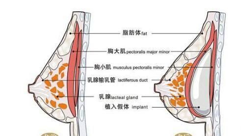 隆胸之后会怎样(隆胸后怎么样恢复最快)图2