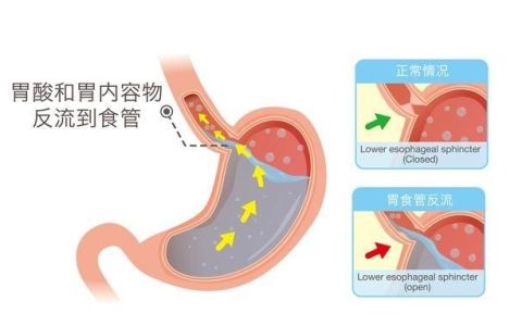 胃酸倒流有什么症状(胃酸倒流的症状怎么解决)