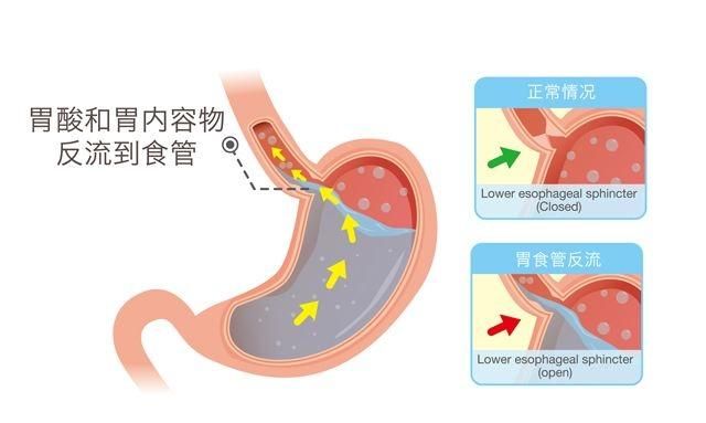 胃酸倒流有什么症状(胃酸倒流的症状怎么解决)图1