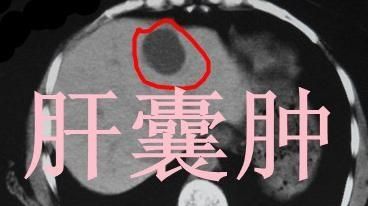 肝右叶囊性占位性病变是什么意思图3