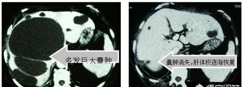 肝右叶囊性占位性病变是什么意思图5