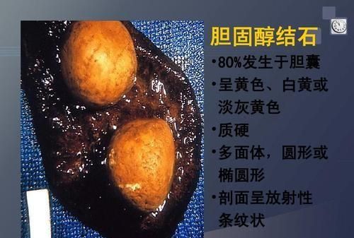 胆囊结石有什么表现,胆囊结石有什么表现症状图1