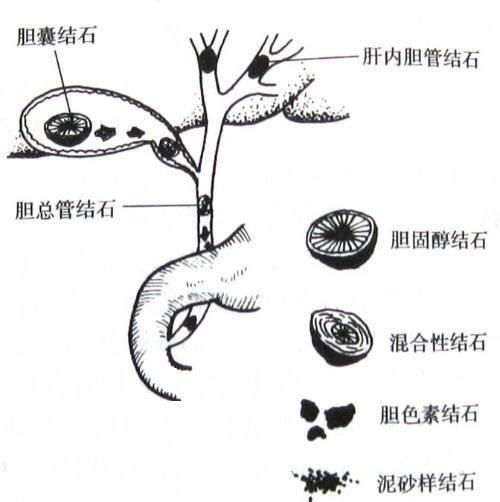 胆囊结石有什么表现,胆囊结石有什么表现症状图2