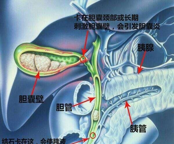胆囊结石有什么表现,胆囊结石有什么表现症状图4