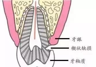 楔状缺损一般是什么原因造成的(牙齿楔状缺损树脂粘能维持多久)图2