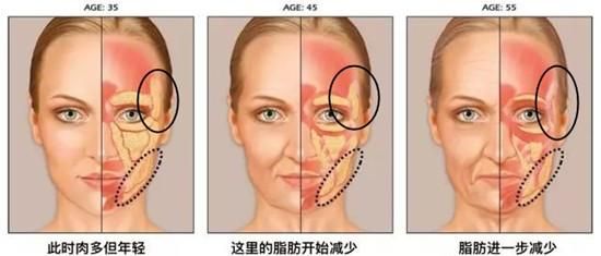 太阳穴凹陷，看起来额头窄，颧骨高，有没有同款"脸型"?