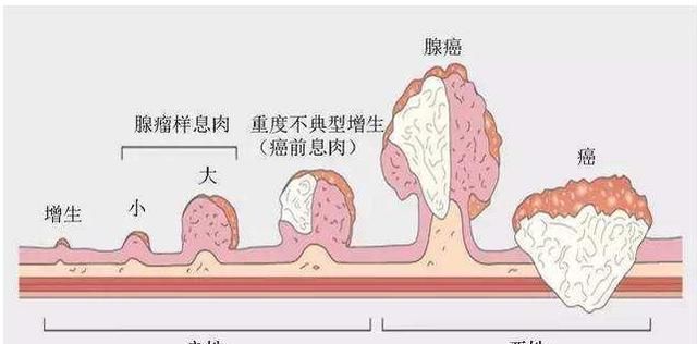 肠多发息肉怎么办,肠部多发息肉怎么办图2