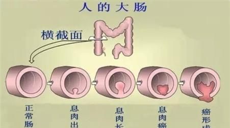 肠多发息肉怎么办,肠部多发息肉怎么办图4