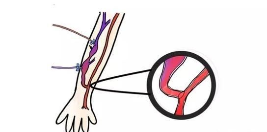透析病人动静脉内瘘如何保护图1