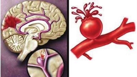 脑血管疾病有哪些图1